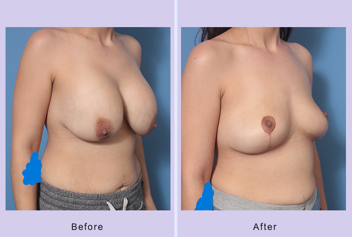 Before and After Image: Breast Implant Removal – Case 7 - right-front-oblique