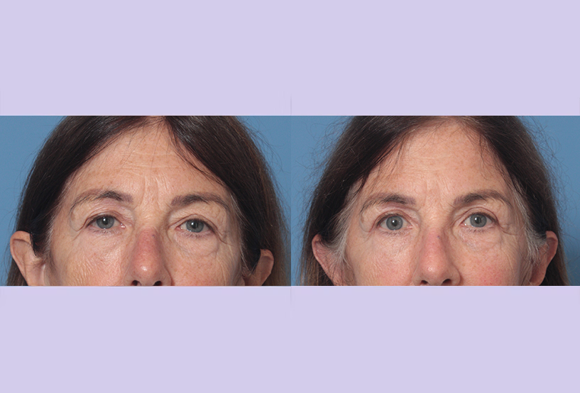 Before and After Image: Upper and Lower Blepharoplasty – Case 45