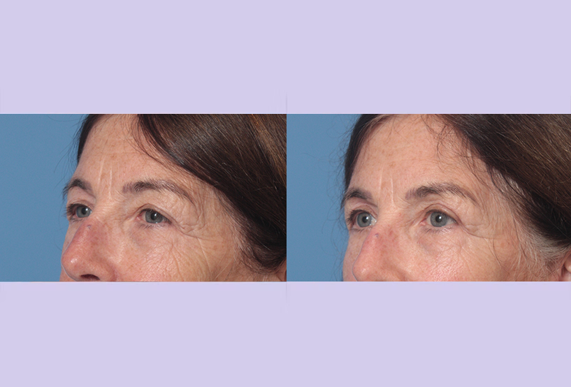 Before and After Image: Upper and Lower Blepharoplasty – Case 45 - left-front-oblique