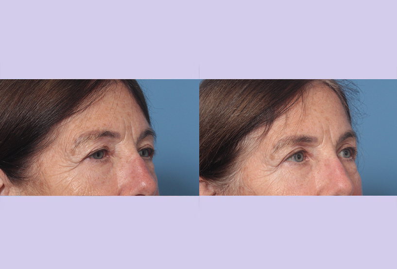 Before and After Image: Upper and Lower Blepharoplasty – Case 45 - right-front-oblique