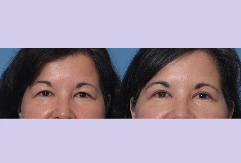 Before and After Image: Upper and Lower Blepharoplasty – Case 46