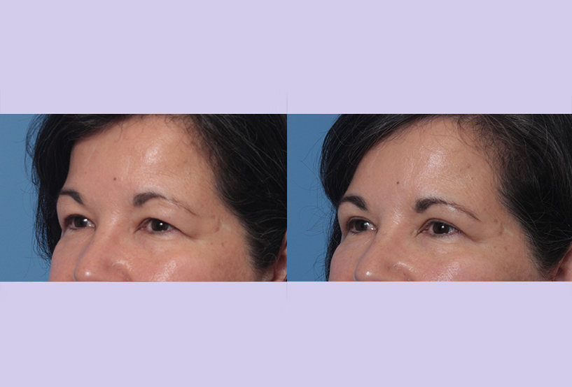 Before and After Image: Upper and Lower Blepharoplasty – Case 46 - left-front-oblique