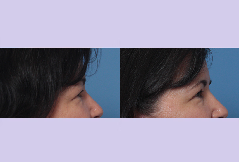 Before and After Image: Upper and Lower Blepharoplasty – Case 46 - right-side