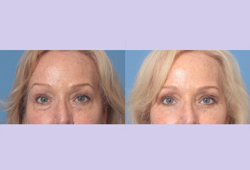 Before and After Image: Upper Blepharoplasty – Case 47 - front