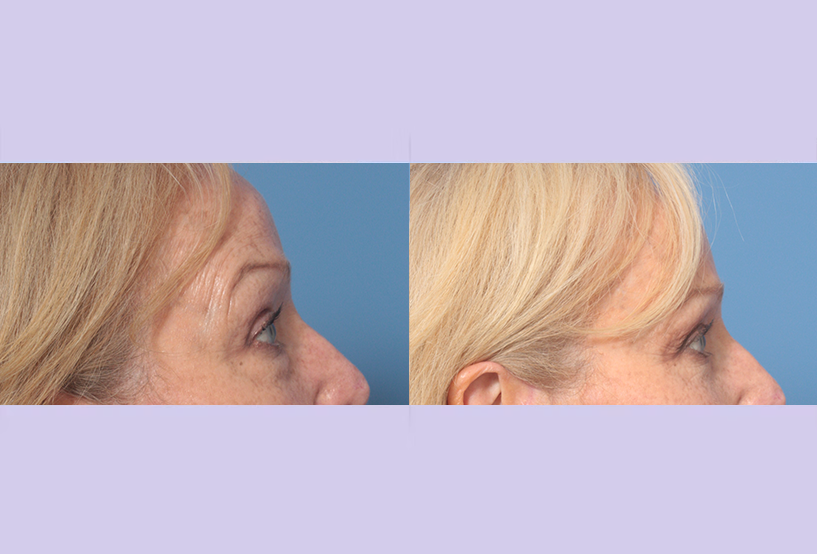 Before and After Image: Upper Blepharoplasty – Case 47 - right-side