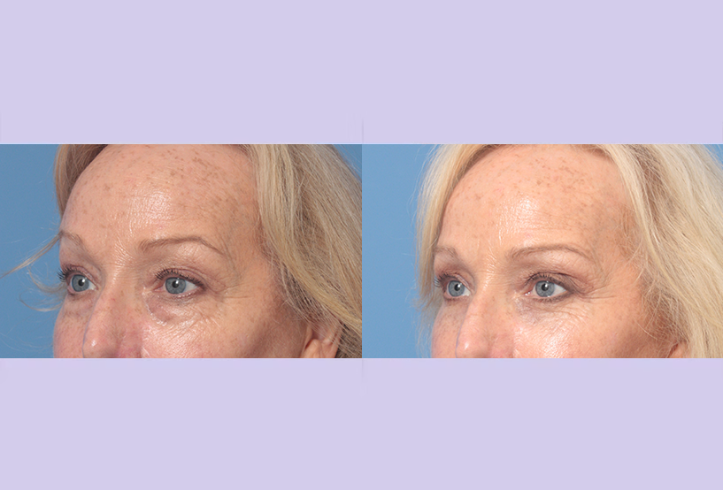 Before and After Image: Upper Blepharoplasty – Case 47 - left-front-oblique