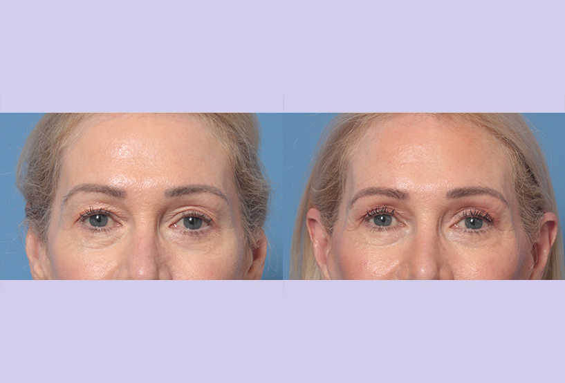 Before and After Image: Upper Blepharoplasty – Case 48