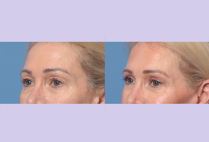 Before and After Image: Upper Blepharoplasty – Case 48 - left-front-oblique