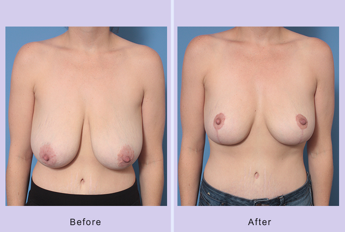 Before and After Image: Breast Reduction – Case 10 - front