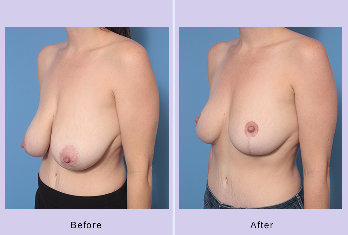 Before and After Image: Breast Reduction – Case 10 - left-front-oblique