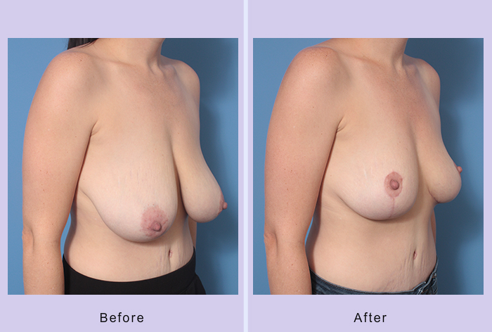 Before and After Image: Breast Reduction – Case 10 - right-front-oblique