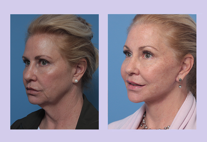 Before and After Image: Lower Facelift – Case 26 - left-front-oblique