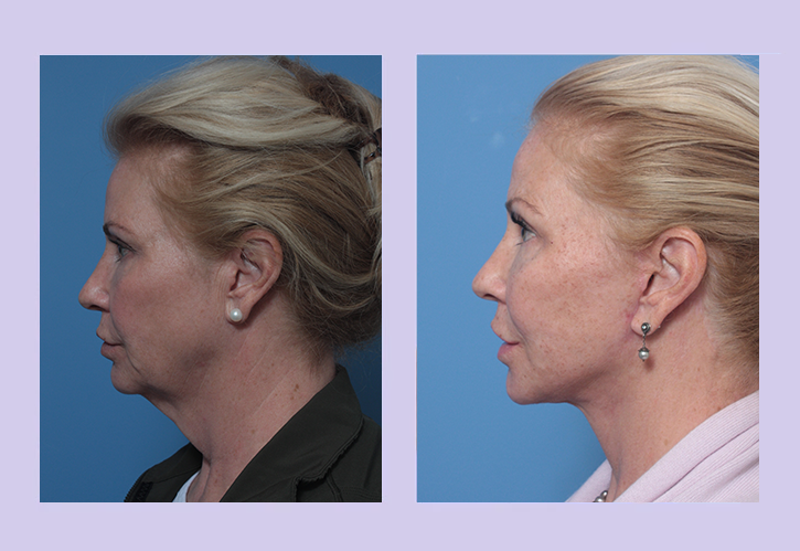 Before and After Image: Lower Facelift – Case 26 - left-side