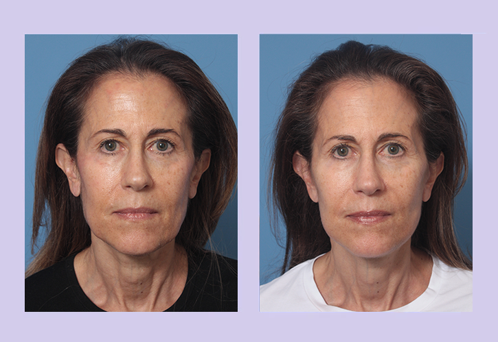 Before and After Image: Lower Facelift – Case 27 - front