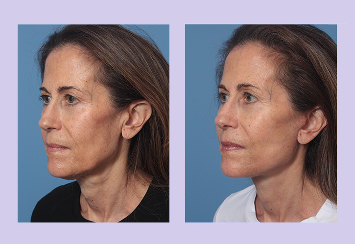 Before and After Image: Lower Facelift – Case 27 - left-front-oblique