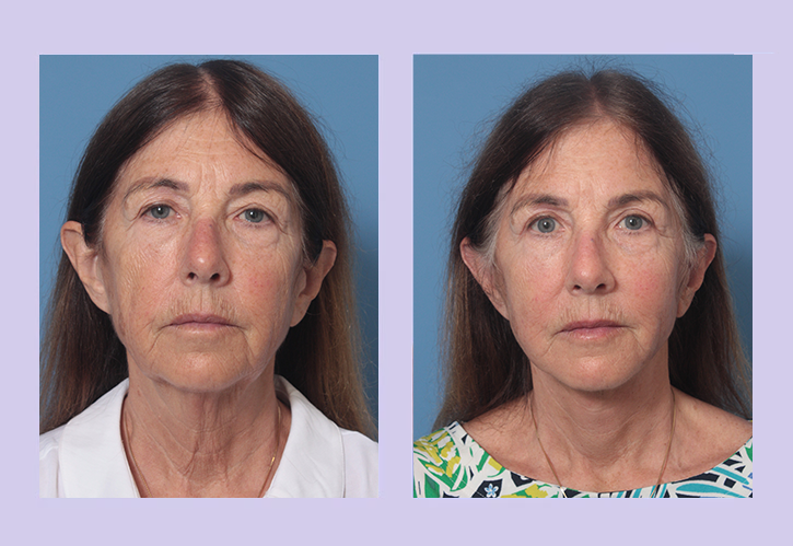 Before and After Image: Lower Facelift – Case 28 - front