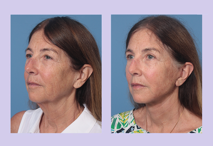Before and After Image: Lower Facelift – Case 28 - left-front-oblique