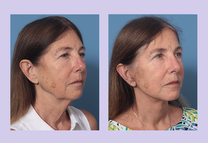 Before and After Image: Lower Facelift – Case 28 - right-front-oblique