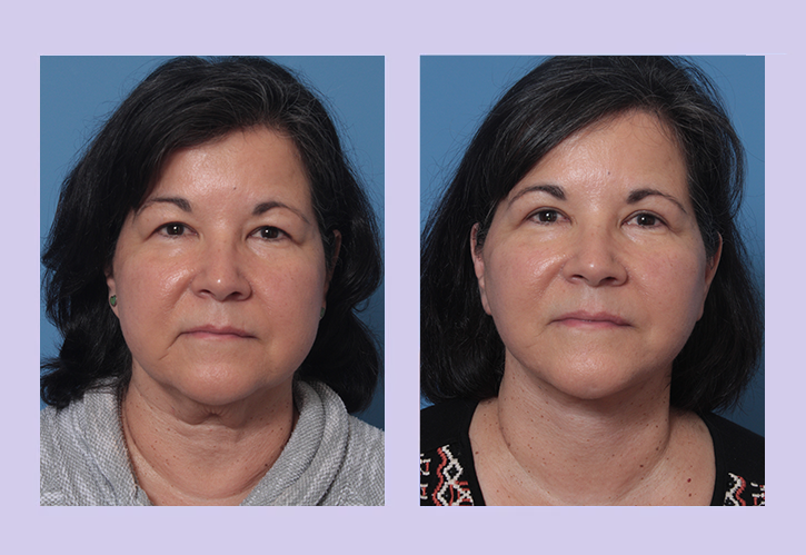 Before and After Image: Lower Facelift – Case 29 - front