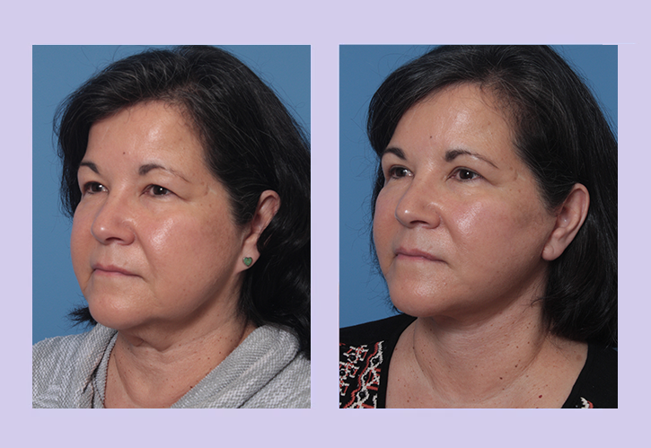 Before and After Image: Lower Facelift – Case 29 - left-front-oblique