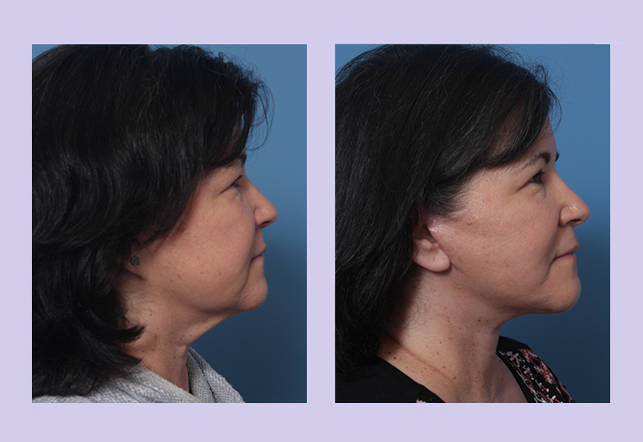 Before and After Image: Lower Facelift – Case 29 - right-side