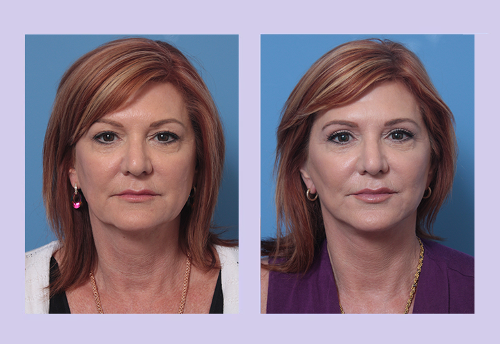 Before and After Image: Lower Facelift – Case 30 - front