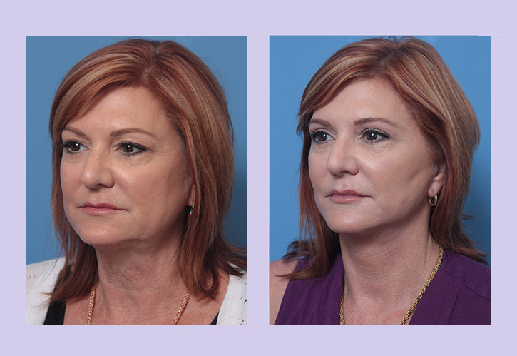 Before and After Image: Lower Facelift – Case 30 - left-front-oblique