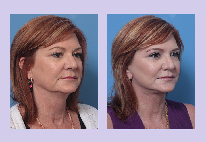 Before and After Image: Lower Facelift – Case 30 - right-front-oblique