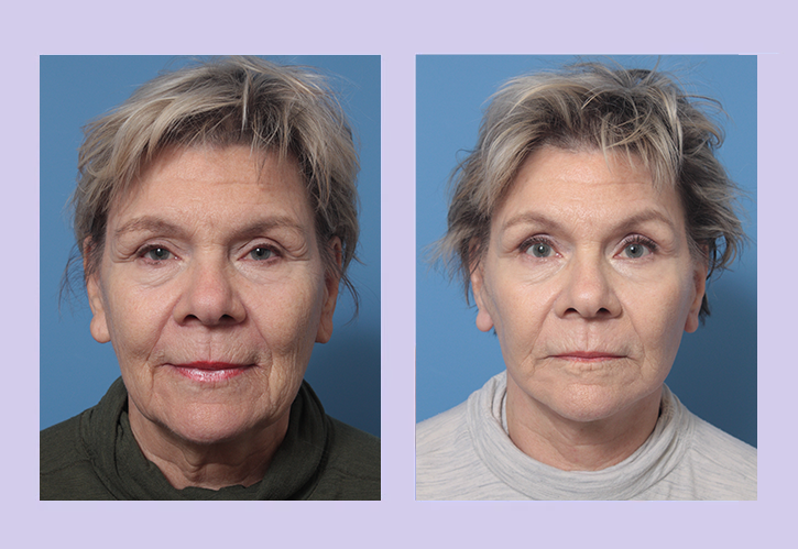 Before and After Image: Lower Facelift – Case 31 - front