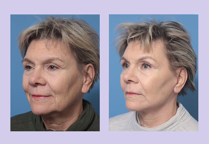 Before and After Image: Lower Facelift – Case 31 - left-front-oblique