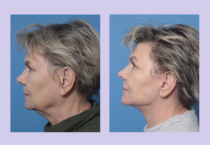 Before and After Image: Lower Facelift – Case 31 - left-side