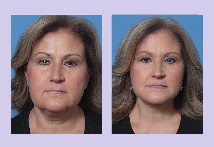 Before and After Image: Lower Facelift – Case 32 - front
