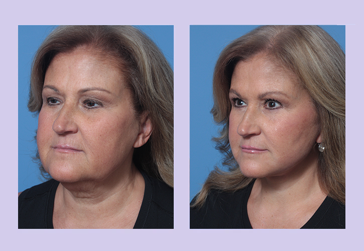 Before and After Image: Buccal Lipectomy – Case 4 - left-front-oblique