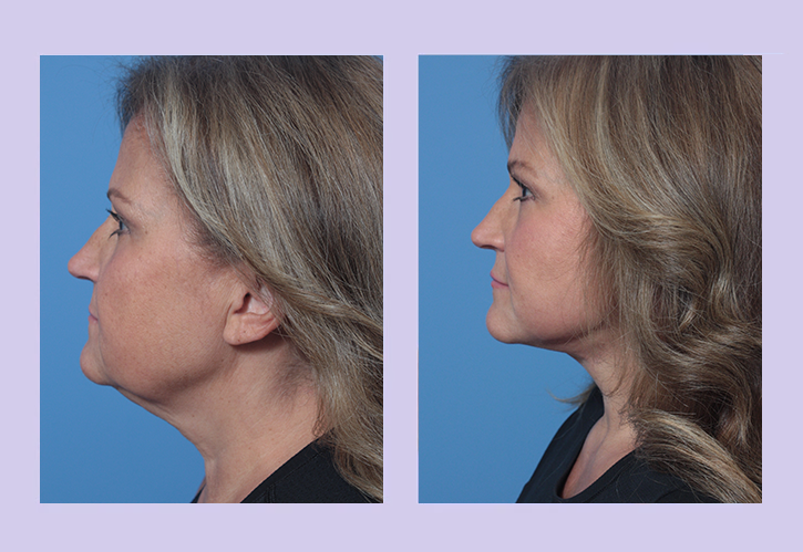 Before and After Image: Lower Facelift – Case 32 - left-side