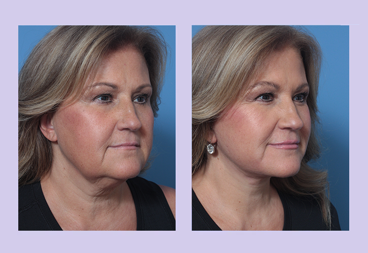 Before and After Image: Buccal Lipectomy – Case 4 - right-front-oblique