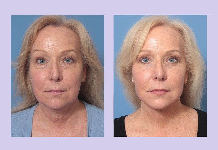 Before and After Image: Lower Facelift – Case 33 - front