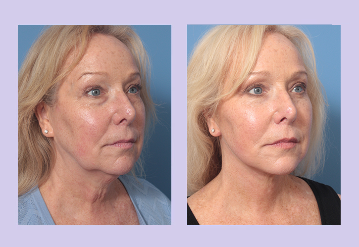 Before and After Image: Lower Facelift – Case 33 - right-front-oblique
