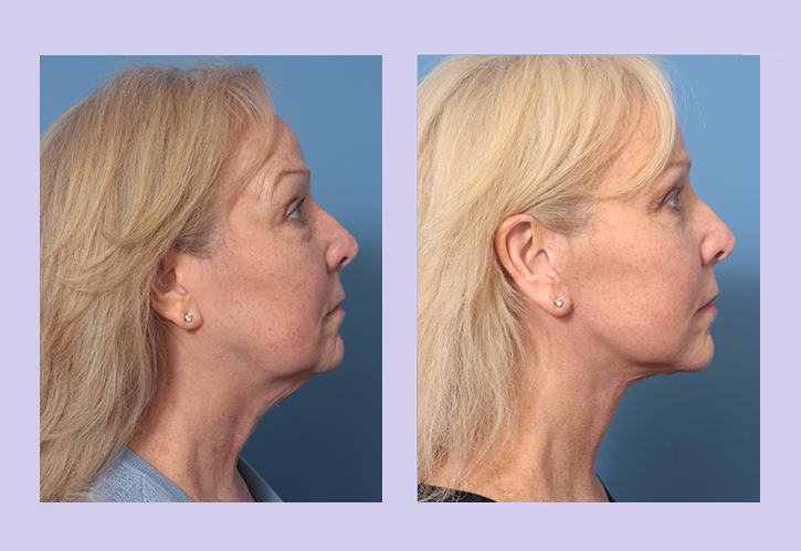 Before and After Image: Lower Facelift – Case 33 - right-side