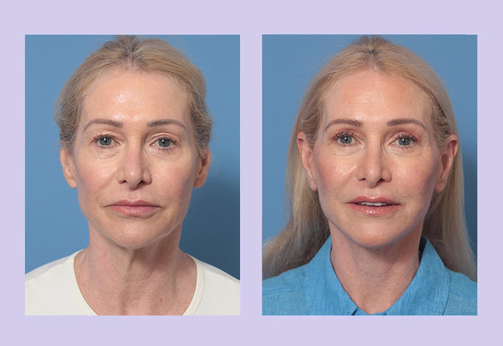 Before and After Image: Lower Facelift – Case 34 - front