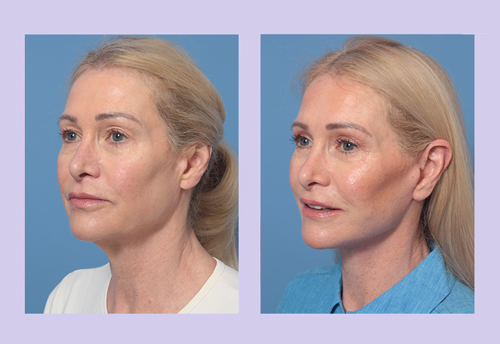 Before and After Image: Lower Facelift – Case 34 - left-front-oblique