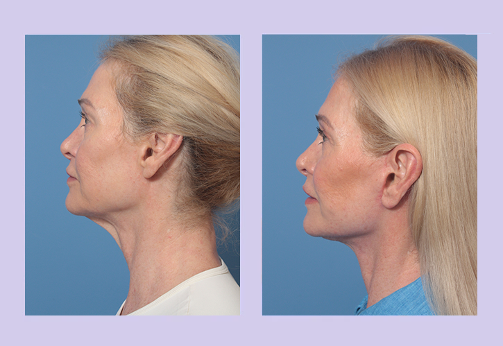 Before and After Image: Lower Facelift – Case 34 - left-side