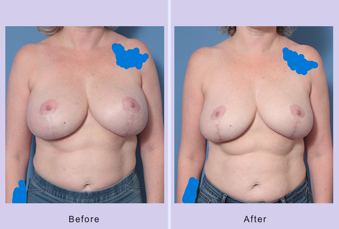 Before and After Image: Breast Implant Removal – Case 8 - front