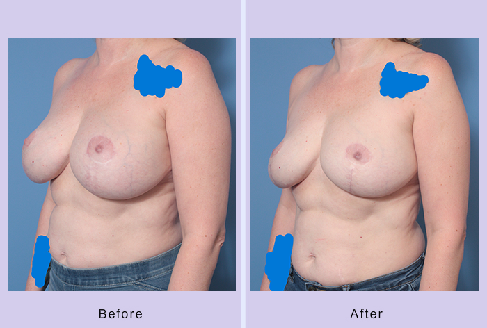Before and After Image: Breast Implant Removal – Case 8 - left-front-oblique