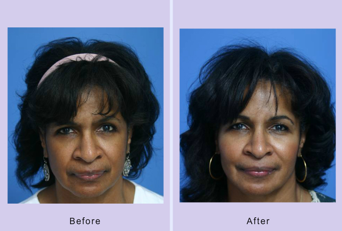 Before and After Image: Browlift – case 4 - front