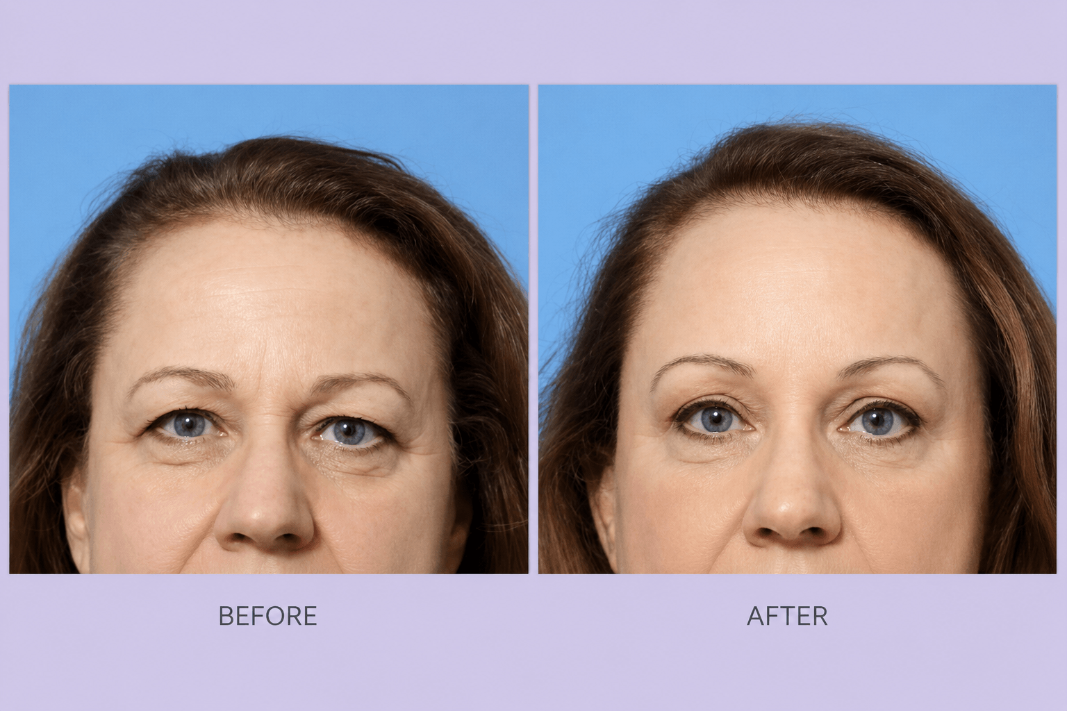 Before and After Image: Browlift – case 7 - front